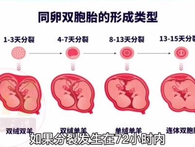 借着上一期的专题,这次向大家详细介绍下如何区分双胞胎的类型!#同卵双胞胎 #异卵双胞胎 @抖音小助手 #创作灵感
