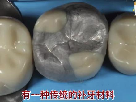 科普补牙知识:口腔界的诺基亚,补牙用的银汞合金被淘汰的原因#中国牙病防治基金会口腔健康科技馆