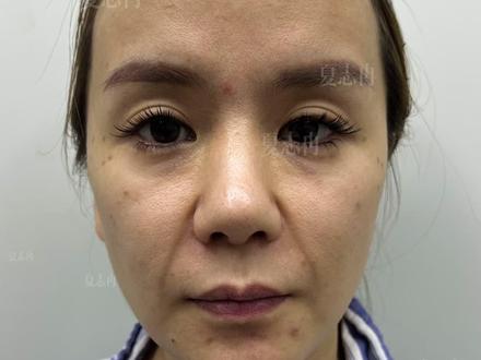 30-50岁抗衰:面部提升维持时长揭秘 #苹果肌下垂怎么提升去#垮脸怎么办#面部提升做什么项目#口角囊袋怎么解决#面部提升夏志冉