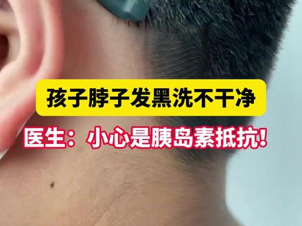 孩子脖子腋窝黑黑的,怎么洗也洗不干净!小心是 #胰岛素抵抗 #黑棘皮病 #脖子黑 #肥胖 #皮肤问题