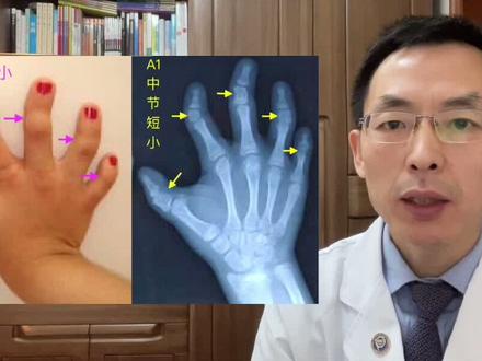 短指症的A1型:5指均中节短小🌹 #短指症A1型 #短指 #短指症 #斜指 #医学科普