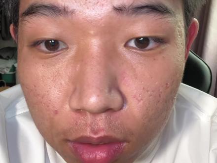 浙江县城普通考生,从前心比天高,总笃定自己轻松630、640。
三模稳定540,次次归咎粗心,不愿承认自身短板。
最终613是高中最高分,常年不破百的英语冲到120,超出预估。
家人只觉得过600就足够,没人懂我心里的落差。
数学选填仅扣5分,却因急躁、粗心浪费大量时间,大题频频丢分,原本有望135+,满是遗憾。
再多假设也无法重来,高考落幕,奔赴下一程人生。#查完高考分数的我 #高考出分那一刻 #高考上热门 #高考出分以后 #心态