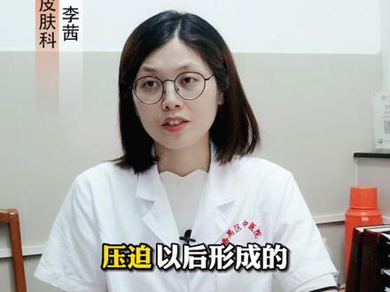 手上起#老茧 ,觉得影响美观或者摸着不舒服,可以试试这样祛除#科普 #皮肤 #运动员 #劳动者
