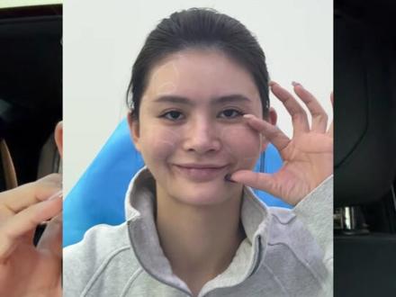 为什么一个月就可以紧、薄、贴😍#馒化 #去馒化 #皮贴骨 #馒化打薄 #面部打薄