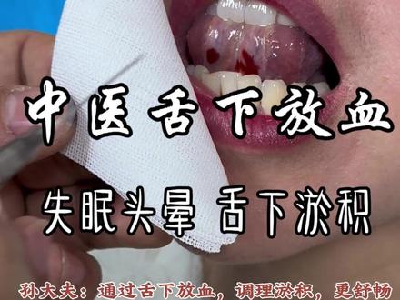 中医舌下放血,失眠头晕,舌下 淤积导致 #舌下放血 #中医针灸 #中医埋线 #洛阳孙大夫