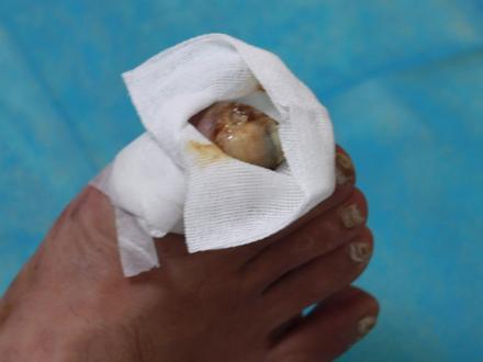 脉管炎怎么治 #脉管炎 #治疗脉管炎老烂腿久不愈合 #中医