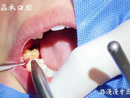 #牙齿健康 独创太极法拔牙