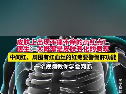 皮肤上出现不痛不痒的小红点? 医生:这些是良性的血管瘤 中间红痣周边布满血丝的是蜘蛛痣 可能是肝脏、血管存在异常情况