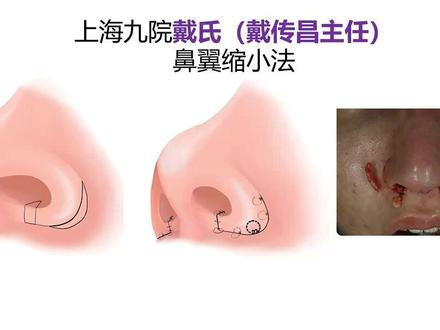 上海九院戴氏鼻翼缩小术 鼻翼缩小是非常精细的手术,稍有不慎容易掉入坑导致不良手术效果,由于东西方人种解剖组织差异,我们不能完全照搬西方方法,应该设计适合东方人的方法,这里介绍我的老师上海九院戴传昌主任的方法#鼻翼宽大 #鼻翼缩小 #鼻整形 #上海九院