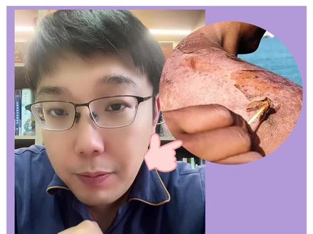 感谢战士的无私奉献,愿早日康复!感谢@中国青年报#樊哥撩皮肤 #战士的生活 #晒伤处理