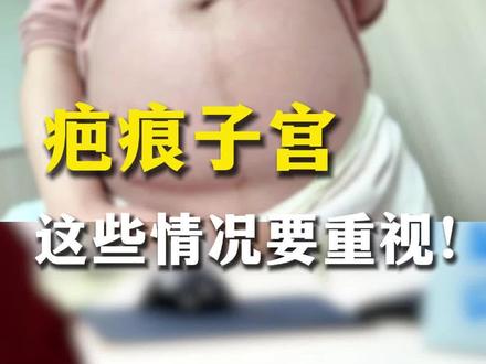 再次剖宫产宝妈请注意!疤痕子宫遇到这些情况…… 要重视!@荆州市妇幼保健院 #疤痕子宫 #剖宫产#医学科普#孕期知识#生娃