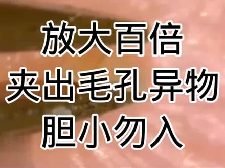 解压,放大百倍,沉浸式,清理脸部毛孔!#深层毛孔清洁 #痘痘黑头粉刺拜拜 #解压视频 #细胞夹
