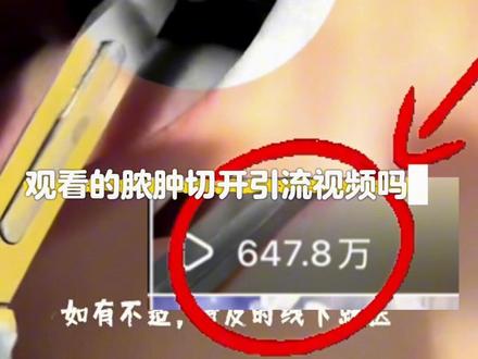 百万网友关注的牙肿案例,后续来了 #牙龈脓包 前很多人关注的脓肿案例,今天来复诊啦。
经过切开引流和根管治疗,脓包消了,脸也不肿了,恢复得很理想。
提醒大家:牙龈发炎、脸肿千万别拖,更不要自己乱挤,及时处理才能少遭罪。
口腔健康,别忽视。#口腔科普 #牙龈脓包 #根管治疗 #牙医@抖音小助手 @抖音安全与信任中心