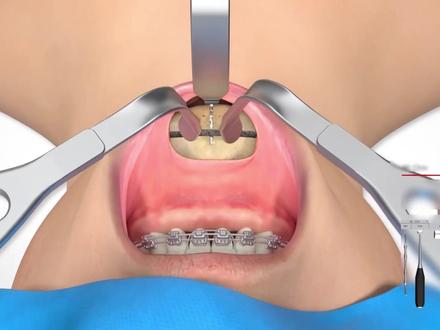 动画展示颏成型术#口腔科普 #口腔