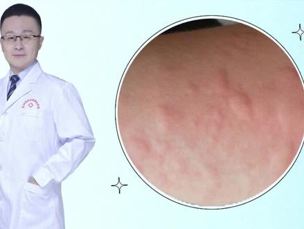 四种常见荨麻疹,处理方法看这里#皮肤 #医学科普 #荨麻疹 #过敏