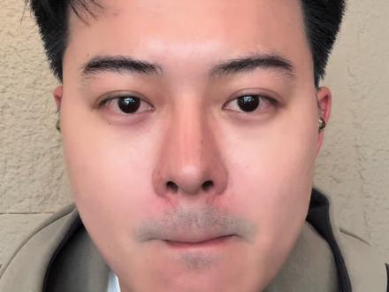 天塌了,biu完瘦脸💉成青蛙了…… #瘦脸 #轮廓 #下颌线 #医美 #vlog日常