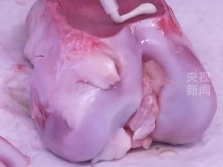 断骨黏合只需3分钟!我国自主研发“骨02”胶水,未来打一针可实现骨黏合。目前已完成临床150余例病人骨折治疗。(来源:@央视新闻@浙江卫视)