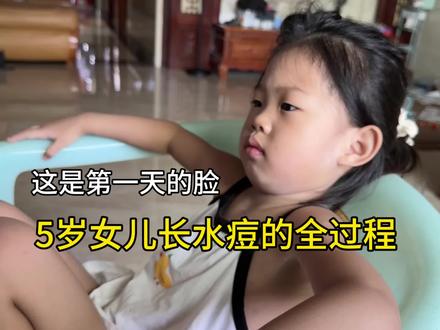 5岁女儿出水痘的过程。#带娃日常 #宝妈 #vlog日常