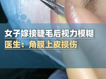 2月4日消息,女子嫁接睫毛后出现视力模糊被送进急诊,医生:角膜上皮损伤,假睫毛胶水残留所致 #大象主播说