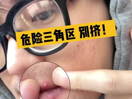 “痘痘星人”必须要知道的知识点——面部危险三角区的痘痘不能挤!小心颅内感染!#痤疮 #痘痘 #女生必看 #冷知识 #知识分享