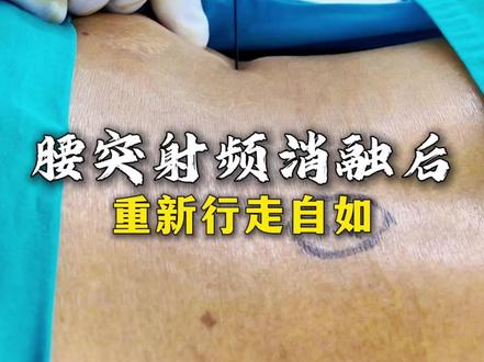 这位患者是腰5骶1椎间盘突出,保守了大半年,整个右侧屁股连带大腿麻木,下不了床。尝试过许多治疗,全都没有效果,射频消融后,不疼了,行走自如。#腰疼#腰痛#腰疼腿疼#腰椎间盘突出