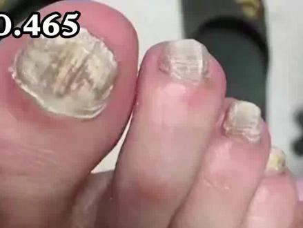 #灰指甲总是治不好,口服药伤肝该不该吃?医生告诉你真相#健康 #科普