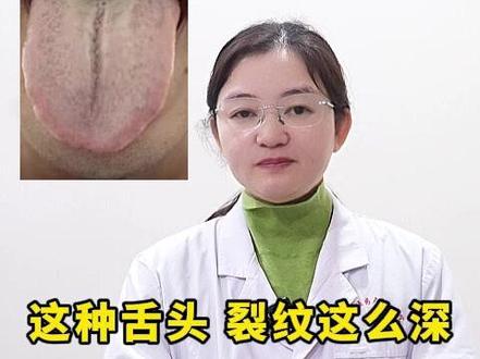 这种舌头,裂纹这么深,猛灌补药只会火上浇油 #裂纹舌 #医学科普 #抖出健康知识宝藏 #知识分享