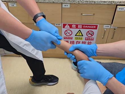 这是2025-07-05我值班时候遇到的一例儿童骨折之尺桡骨远端双骨折手法复位的过程。
9岁孩子暑假到珠海亲戚家度假,不小心摔了一跤导致手腕成角畸形,拍片发现尺桡骨远端骨折移位明显。
刚好谢主任今天看错排班,以为他要出门诊,就在医院免费加班。及时打电话给他,他刚好在准备离开回家。
在他的指导下,我们做了手法复位,复位过程其实挺久的,整个时间花了五分多钟,加上前期麻醉以及后期打石膏总共10来分钟。后来他还在那里等待儿童复查片子回来,担心需要调整,我一个人不好操作。
还好复位效果良好,如果可以维持固定的话,这个治疗就可以了,现在就观察后续恢复的情况。#医学科普 #尺桡骨远端骨折 #前臂骨折 #手法复位 #守护健康