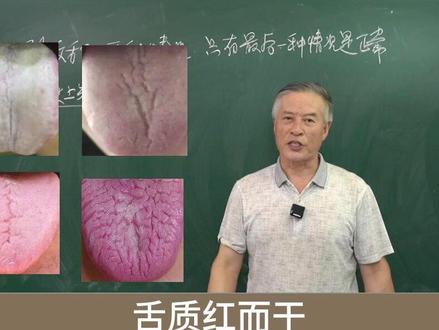 裂纹舌的几种情况,看看你是哪一种? #裂纹舌 #医学科普