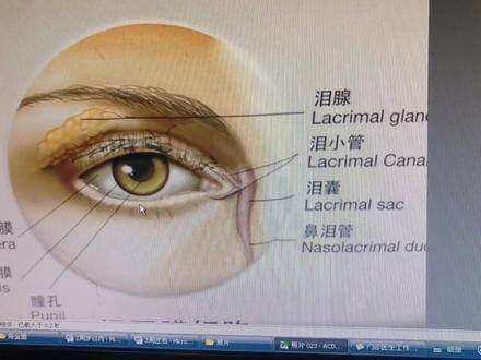 泪道阻塞按压教程#泪道阻塞