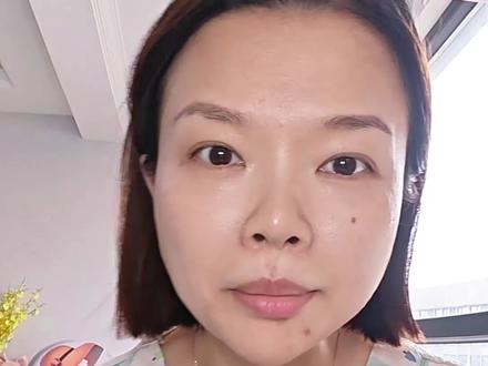 没事别去打肉毒打了只会让你变老变丑,我已经打了两个多月了,在这个过程中经历了压眉,挑眉,脸僵,眼间距变宽,笑不动,也惯自己没有做攻略冲动去打了,以后不打了#肉毒#除皱#医美
