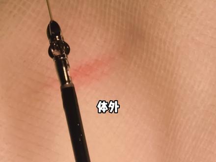 血管内盾机体外是工作展示#血管内盾机 #血管外科