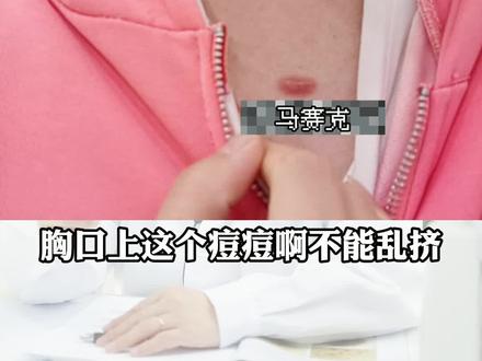 #医学科普艾特出你爱挤痘、吃辣的朋友吧!胸口有痘痘的时候,千万别挤,小心变成瘢痕,跟随你一辈子#健康 #科普 #医学科普