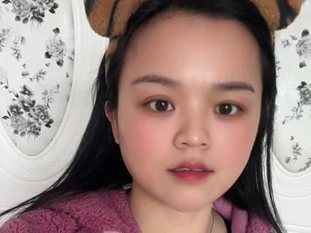 我是先天性斜视,斜视三十年,拍照永远不敢正面看镜头,连跟人说话对视都特别自卑,纠结了好多年才敢做斜视手术,因为之前我都不知道这个斜视是可以做手术矫正的,结婚生完孩子后,偶然在网上看到说斜视可以做手术,家人都觉得没必要,又不是看不见,怕有什么副作用,自己也特别害怕,恐惧,就一直不敢,只能在心里想。一直想,不敢行动。担心手术疼、怕留疤、怕复发,术后才发现这些全是瞎担心,术后第二天拆纱布,世界直接‘正’过来了!当时真的很想哭,很激动,但是不能哭,不能掉眼泪,没人懂我当时的激动,在这里提醒想做的朋友:一定要选正规眼科医院,术前做足视功能检查,术后严格遵医嘱复查,
现在拍照终于敢大胆露脸了!有没有同款斜视困扰的朋友?#斜视 #斜视手术#情感共鸣