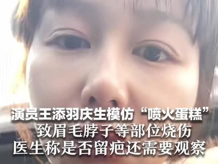 演员王添羽庆生模仿“喷火蛋糕”致眉毛脖子等部位烧伤 医生称是否留疤还需要观察 业内人士:表演用的煤油不是酒精!