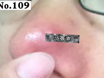 #医学科普 鼻子长红肿的大痘痘,太显眼了很丑,可以这样做!#痘痘 #皮肤