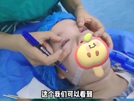 小女孩下睑倒睫矫正,让孩子摆脱睫毛长期摩擦角膜的烦恼#倒睫 #变美 #儿童 #儿童倒睫
