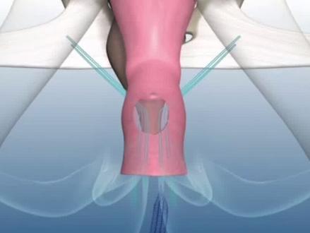 子宫脱垂,多少产后女性的痛!#苏州 #子宫脱垂 #盆底康复 #盆底肌松弛漏尿 #盆底肌修复