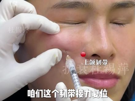 韧带接力提升,4个点还原年轻态!主打剂量克制,点位精准!
#胶原蛋白 #注射美容 #法令纹 #抗衰 #广州注射医生