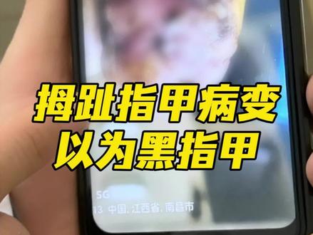 脚趾发黑以为是灰指甲,外院病理:肢端恶黑 #抖出健康知识宝藏#肿瘤专家王春萌#医疗健康创作训练营#拇趾指甲病变 #灰指甲和黑色素瘤的区别