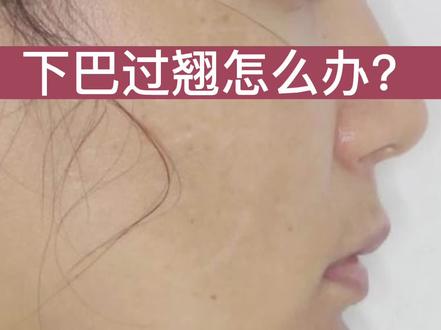 下巴过翘怎么办?#下巴 #月亮脸 #变美那些事 #健康守护计划