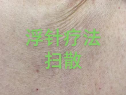 浮针疗法👉扫散#颈肩腰腿疼