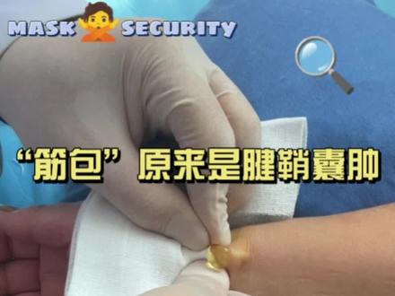 “筋包”原来是腱鞘囊肿#中医 #针灸#腱鞘囊肿#筋包