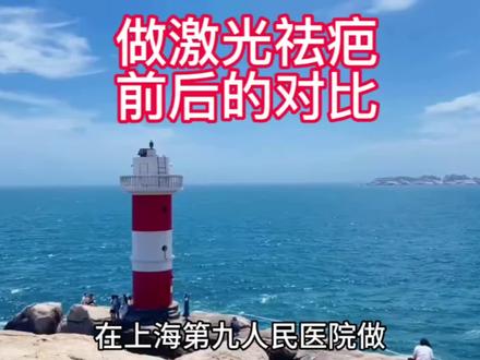 在上海做激光祛疤前后的对比#激光美容 #爱美 #祛疤