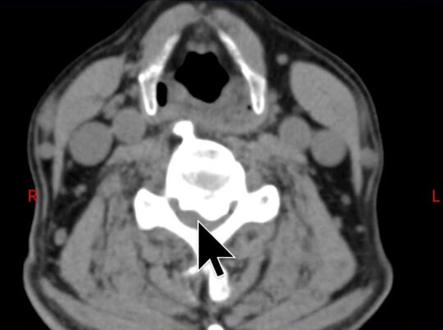 这种颈椎病症状轻容易被忽视,但医生接诊时部分已经截瘫(颈部轻微外伤)!