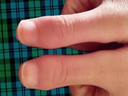 #短指 #拇指短小 #矫形 手指缺失关节,可以移花接木吗?