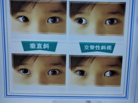 斜视术后用眼注意事项,祝你一次解决斜视问题#斜视 #斜视手术 #斜视矫正 #斜视术后 #视觉训练师大海