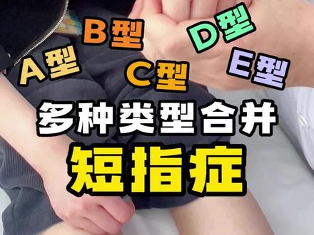 短指症的五大类型(A—E型)#短指症 #短指 #医学科普 #上海六院康庆林