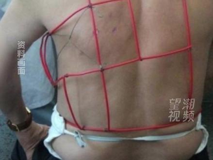 看着让人心疼! 广东阿伯患带状疱疹痛到没法穿衣,自制“衣物隔离架”自救
近日,广东刘伯的经历引发网友关注。他患上带状疱疹后,皮肤只要接触、摩擦衣物就会产生剧烈疼痛,无法正常穿衣,于是为上半身自制了一个“衣物隔离架”。医生表示,这个做法很机智,也能深刻体会到患者承受的痛苦。
带状疱疹俗称“缠腰龙”“蛇缠腰”,是中老年人高发的病毒感染性疾病。超90%的成人体内都携带水痘-带状疱疹病毒,病毒会在神经节内潜伏,当机体免疫力低下时就可能引发疾病。该病早期易误诊漏诊,若错过最佳治疗时机,会并发顽固的带状疱疹性神经痛,严重影响患者生活。
45岁的邹女士就曾受左腰腹部无疱型带状疱疹后遗神经痛困扰长达1年,疼痛呈电击样、烧灼样,严重影响睡眠。最终她在广东省第二人民医院接受了CT引导下背根神经节脉冲射频治疗,仅30分钟疼痛就大幅缓解,当天顺利出院。
专家提醒,带状疱疹通常单侧发病,若出现单侧烧灼样、电击样疼痛,应及时就诊。皮损结痂不代表神经修复完成,疼痛持续超过1个月即为后遗神经痛,拖延越久治疗难度越大。日常保持健康生活方式,避免过度劳累,可有效预防该病。
#带状疱疹 #缠腰龙 #健康科普 #后遗神经痛 #医疗健康专家说