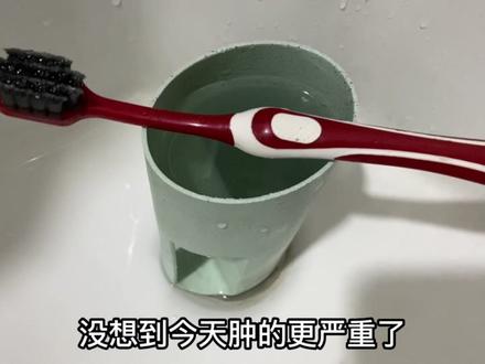激光去除汗管瘤的第三天 整张脸肿得像牛头 比昨天的猪头又大一号 #汗管瘤 #激光 #医院 #治疗 #痘痘肌 #点痣 #过敏脸 #创作灵感